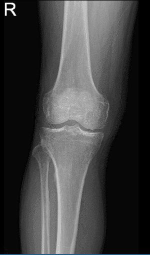 MRI of right knee
