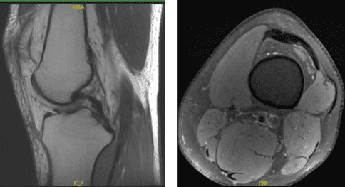 MRI of the back spine