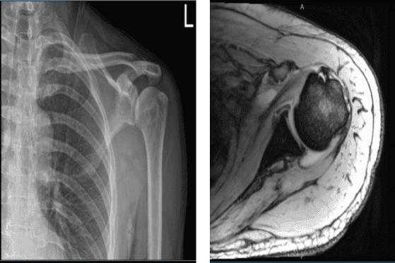 MRI of the left shoulder