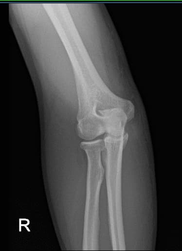Radiografía postoperatoria del codo derecho