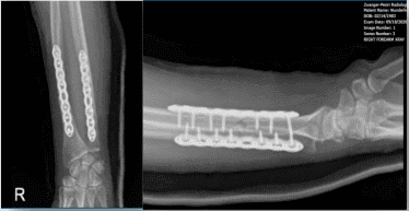 Radiografía del antebrazo derecho - primera semana postoperatoria