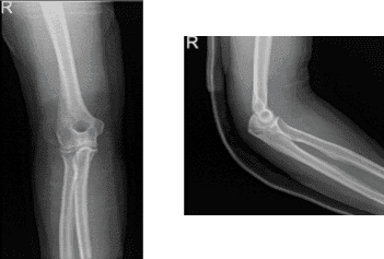 Right elbow x-ray