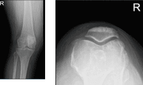 Right knee X-ray