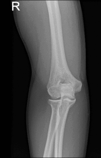 X-ray of right elbow