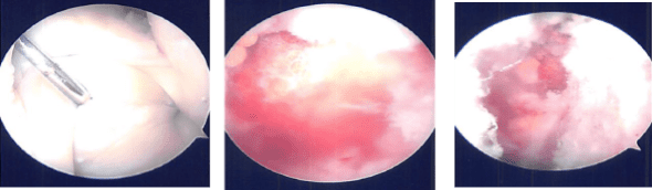 MRI of the right knee