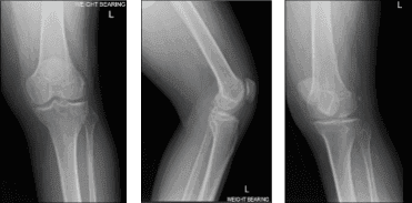 Resonancia magnética de rodilla izquierda