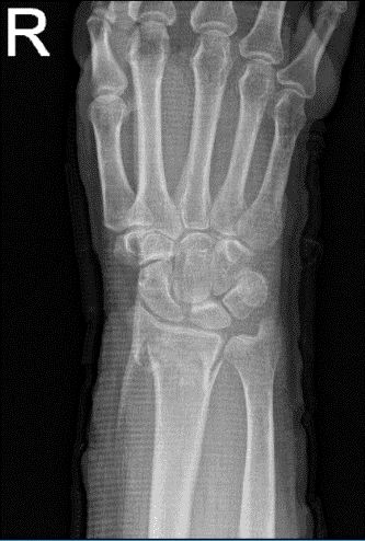 Radiografía de la muñeca derecha 3 o más vistas