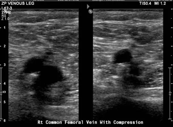 Bilateral de la extremidad inferior venosa Doppler