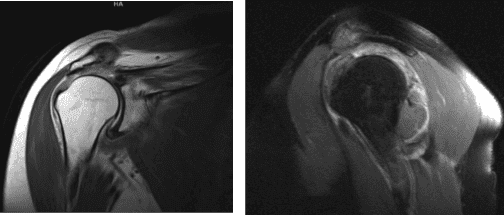 MRI right shoulder non-contrast