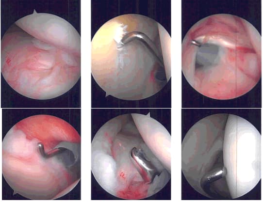 Imágenes de artroscopia intraoperatoria
