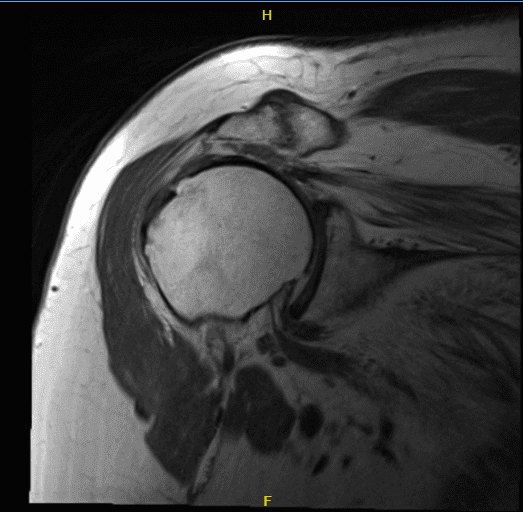 MRI-3T right shoulder non-contrast