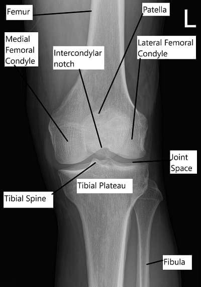 Intercondyler Ridge Tibial Intercondylar Fossa