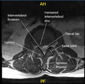bpc-157 intervertebral disc herniation study Case Study: Prolapsed Lumbar Intervertebral Disc Management
