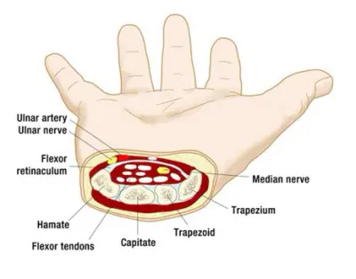 ipamorelin side effects carpal tunnel syndrome Carpal Tunnel Syndrome: Symptoms, Causes, and Treatments main image 1