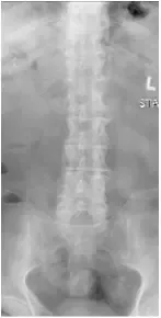 X-rays and MRI of the Lumbar spine showed L4-5 degenerative spondylolisthesis