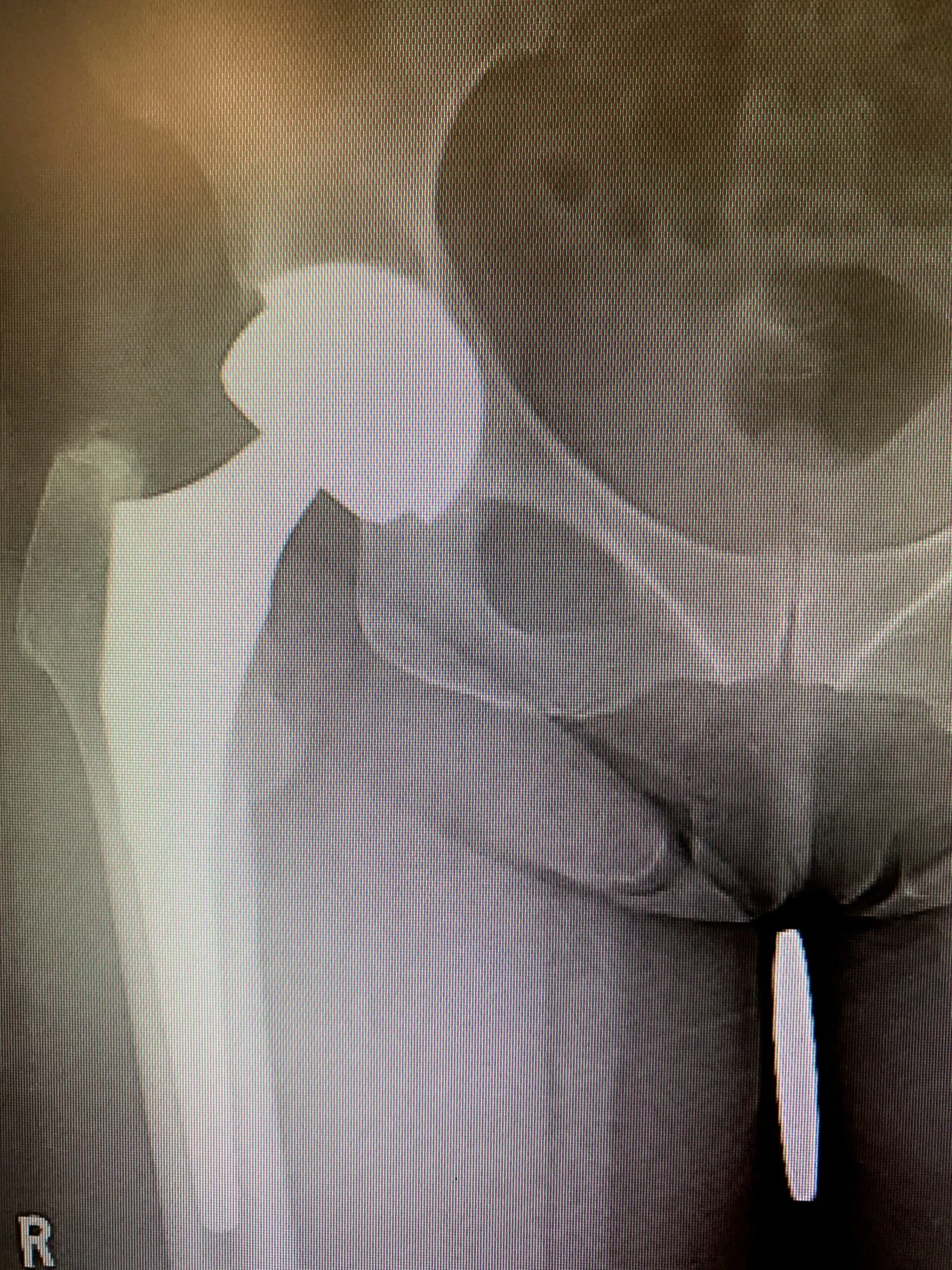 Revision Total Hip Replacement in a 64year old. Isolated acetabular component exchange