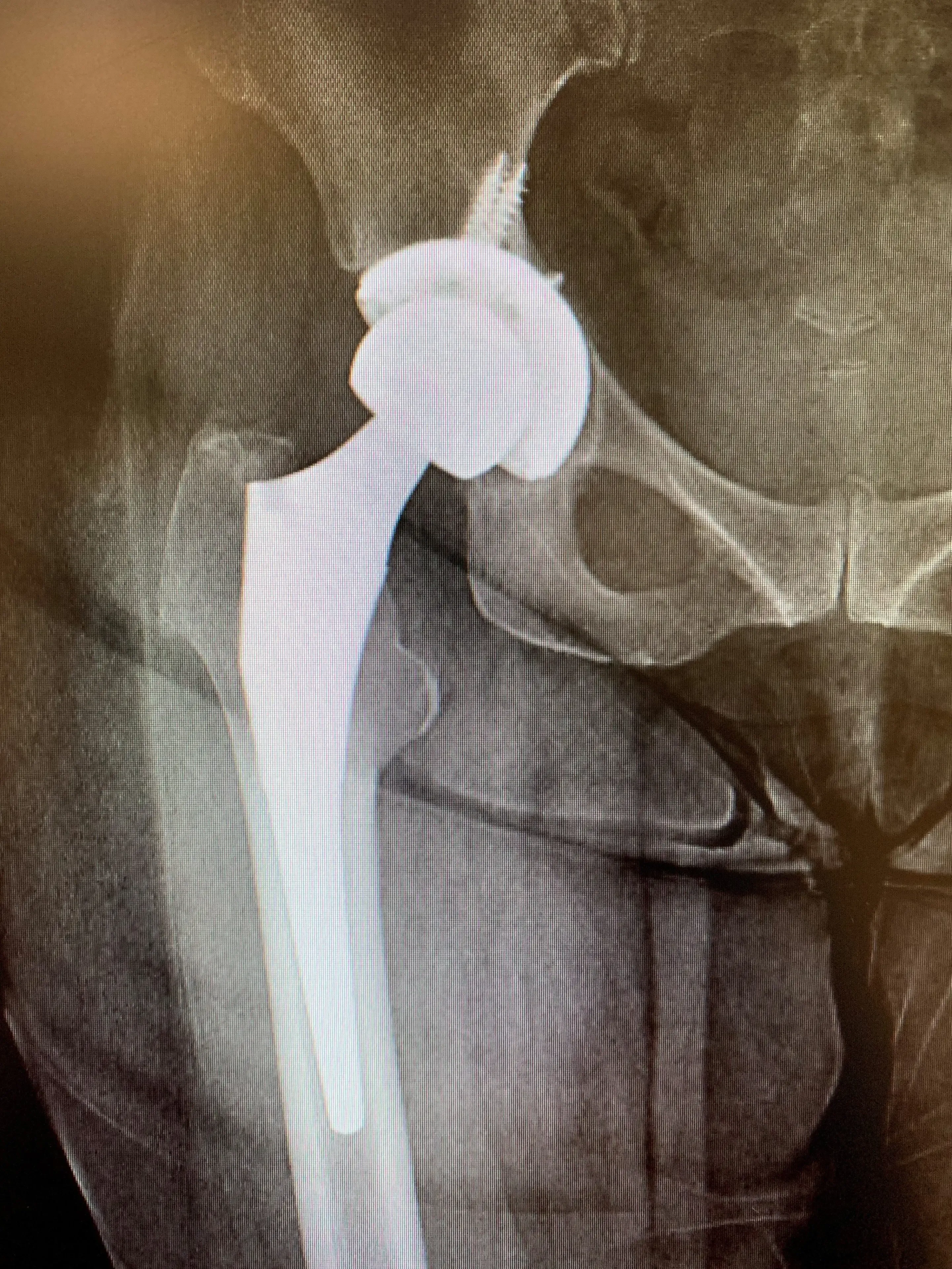 Revision Total Hip Replacement in a 64year old. Isolated acetabular component exchange