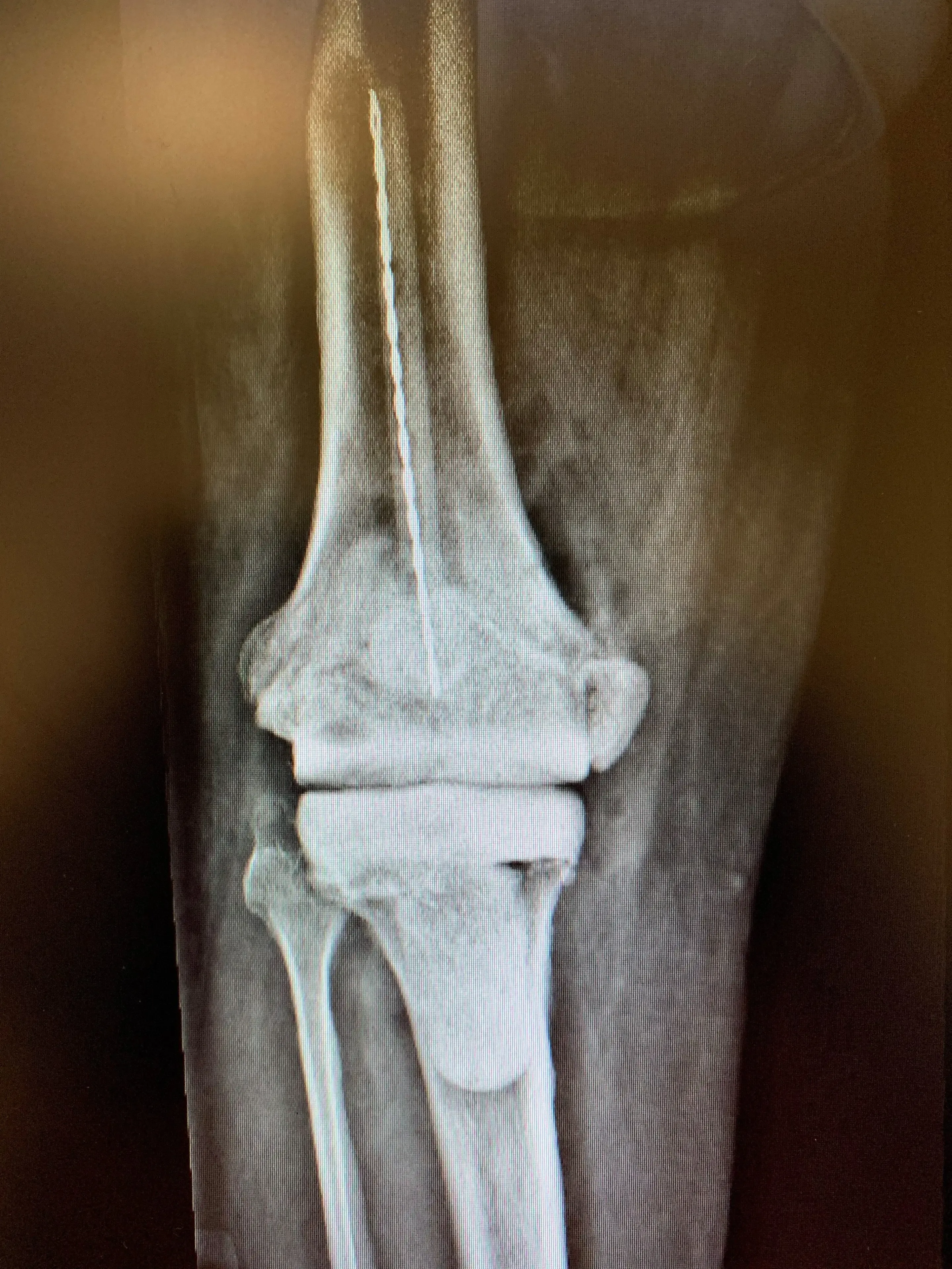 Treatment of infected knee replacement. A staged reconstruction in a 64 year old maleb