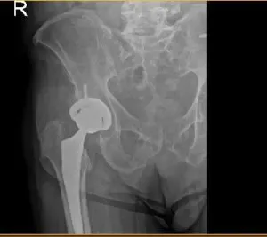Post op hip Xray