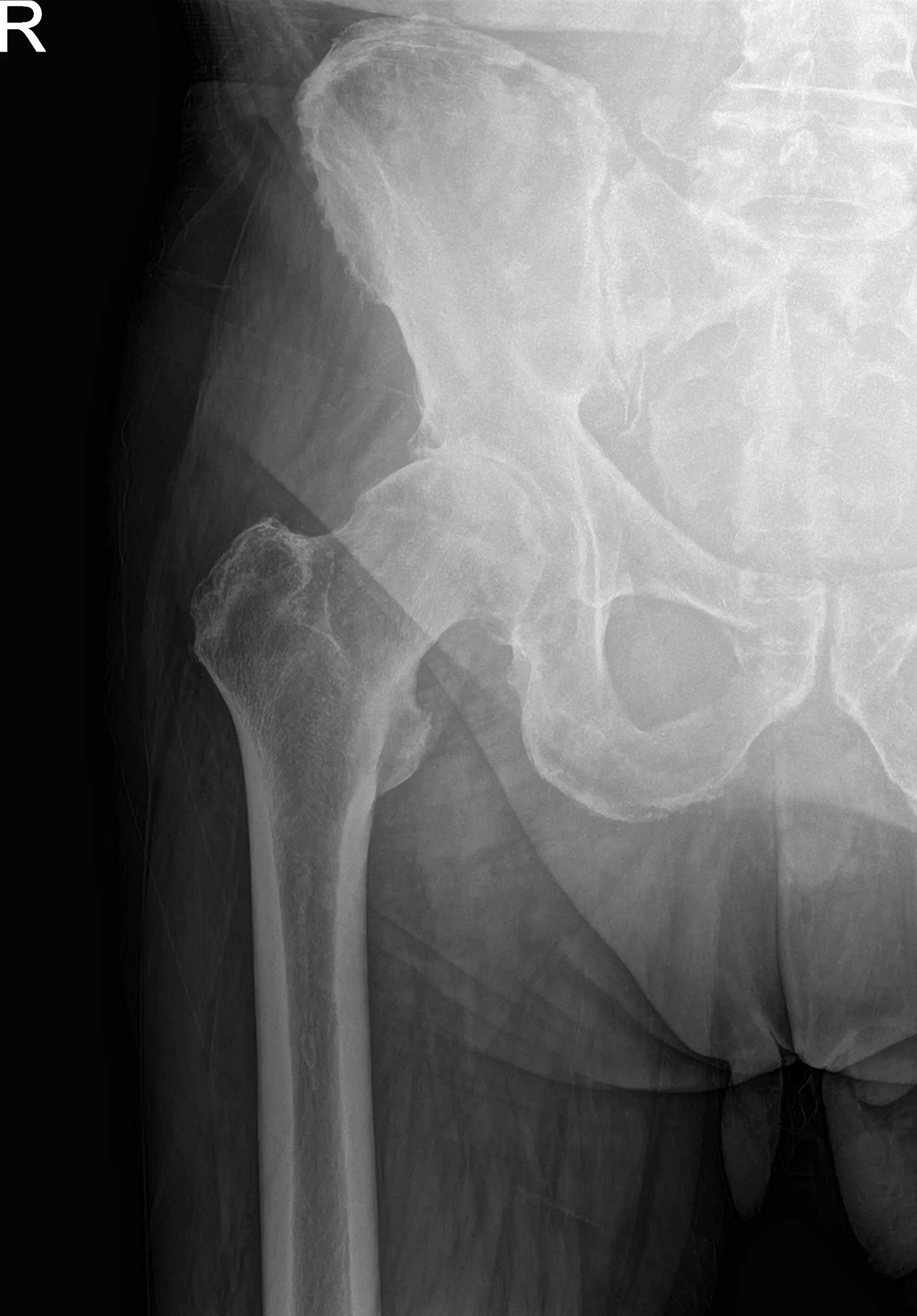Preoperative X-ray images showing AP and frog-leg lateral view of the right hip Preoperative X-ray images showing AP and frog-leg lateral view of the right hip