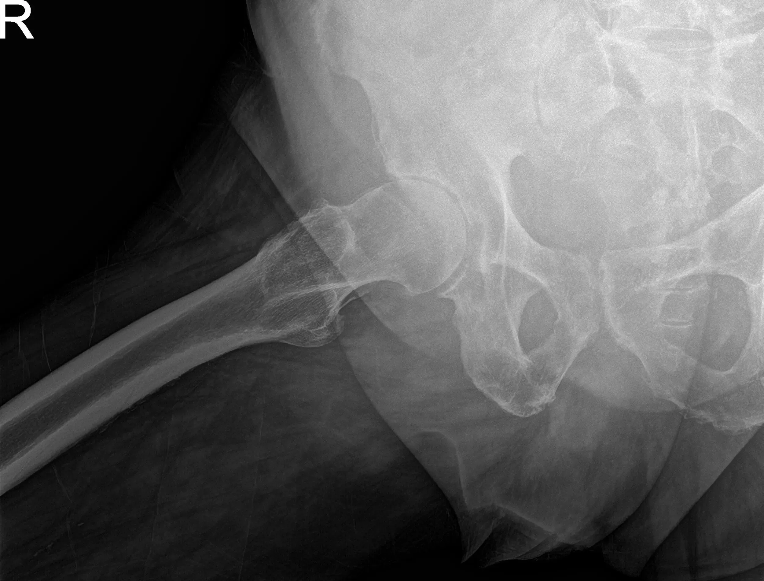Preoperative X-ray images showing AP and frog-leg lateral view of the right hip Preoperative X-ray images showing AP and frog-leg lateral view of the right hip