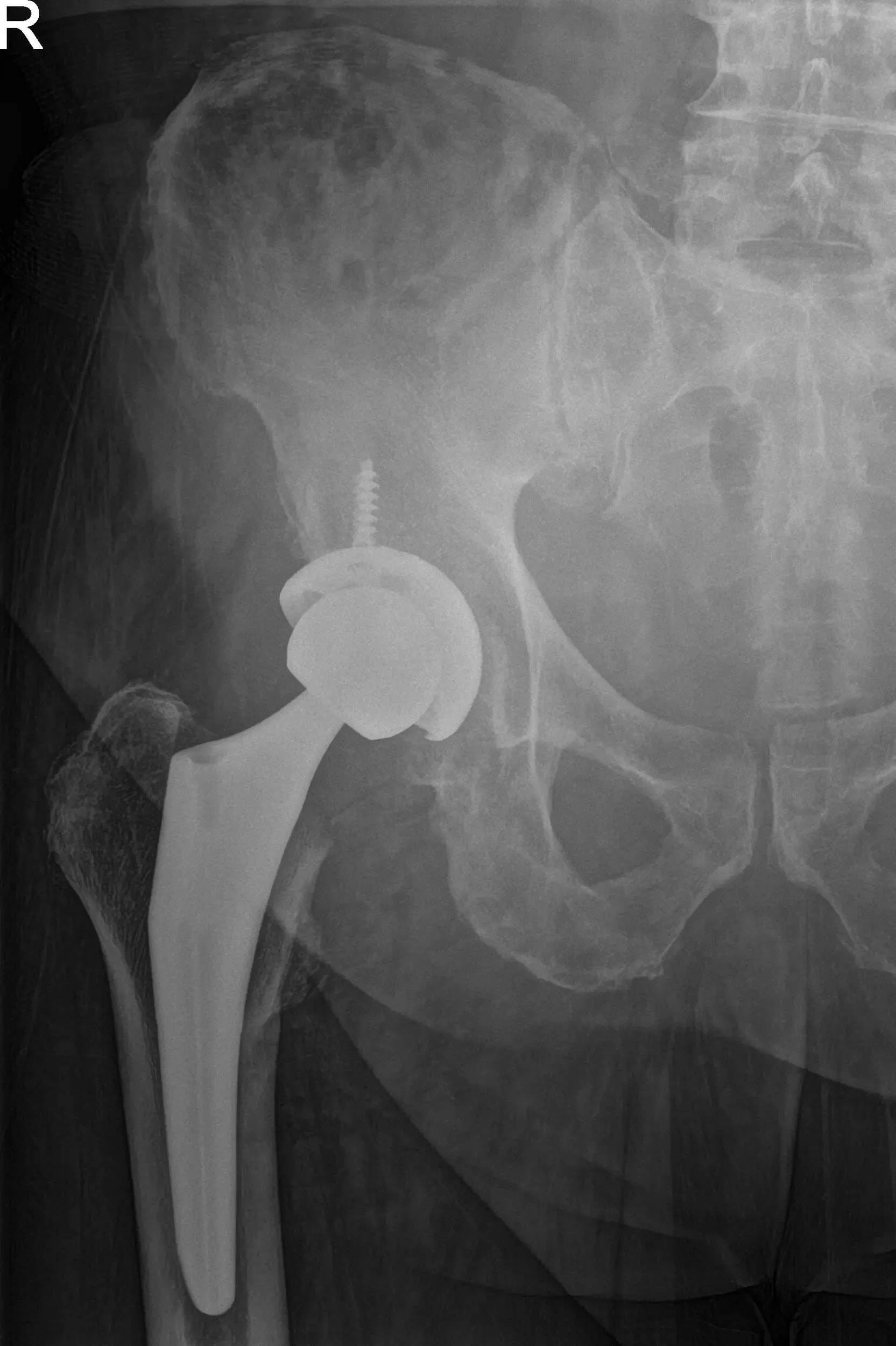 Postoperative X-ray showing AP and frog-leg lateral views of the right hip Postoperative X-ray showing AP and frog-leg lateral views of the right hip