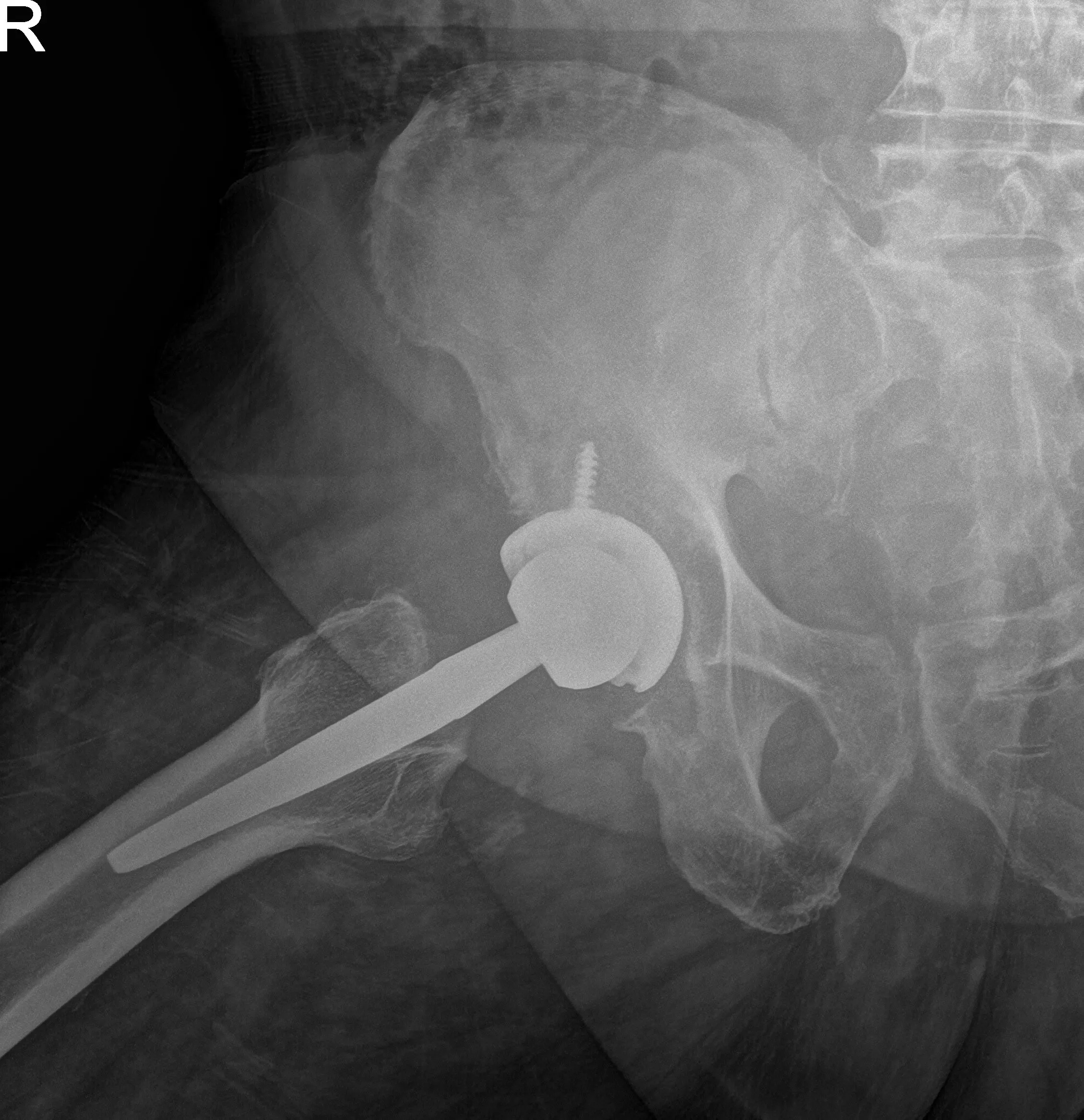 Postoperative X-ray showing AP and frog-leg lateral views of the right hip Postoperative X-ray showing AP and frog-leg lateral views of the right hip