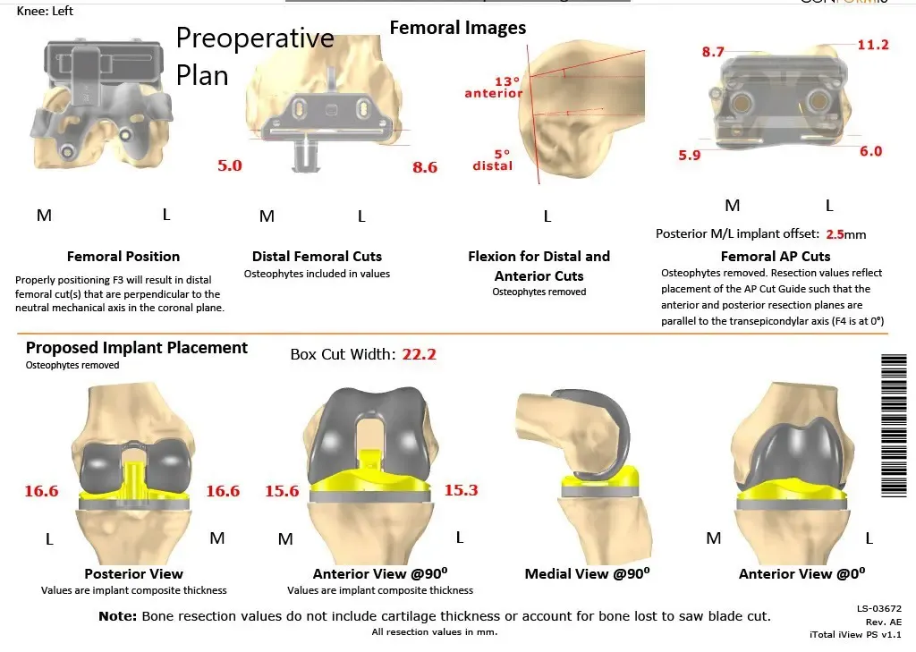 A patient specific surgical plan for a patient at Complete Orthopedics in New York - scan 4