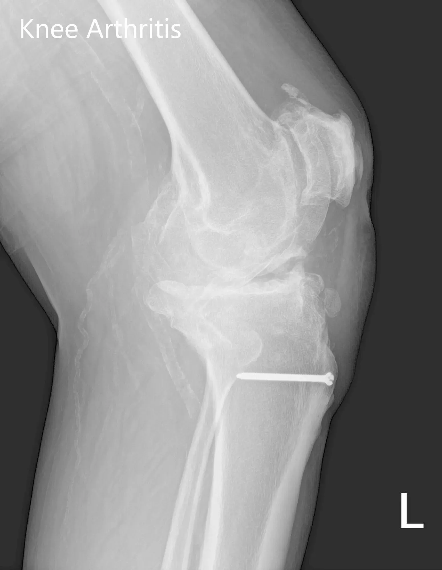 Radiografía preoperatoria de la rodilla izquierda que muestra visión AP y lateral con cambios osteoartríticos degenerativos y hardware retenido en la tibia proximal - img 2