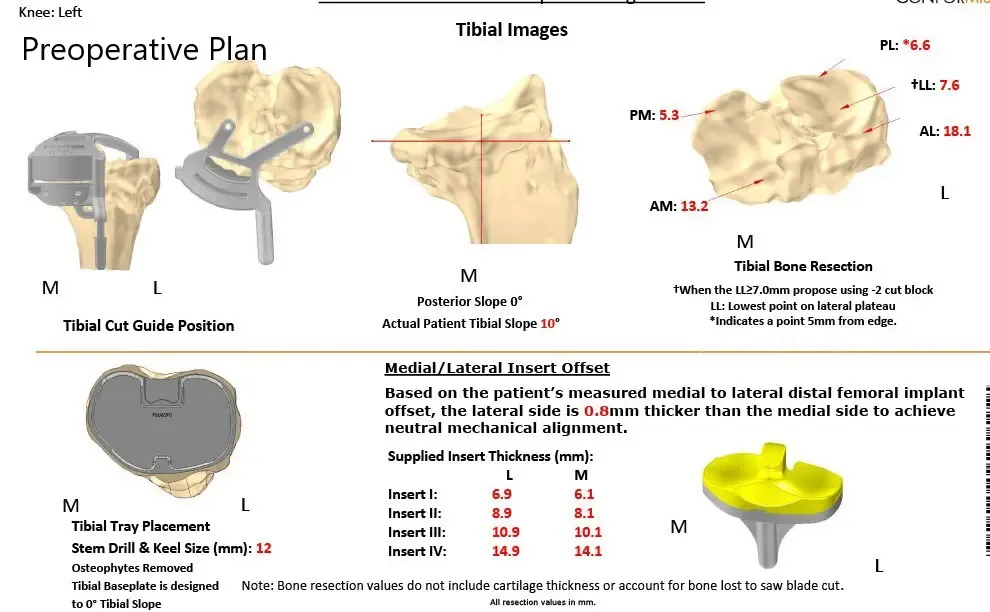Plan quirúrgico completo específico para pacientes en ortopedia para un reemplazo personalizado de rodilla izquierda en una mujer de 59 años
