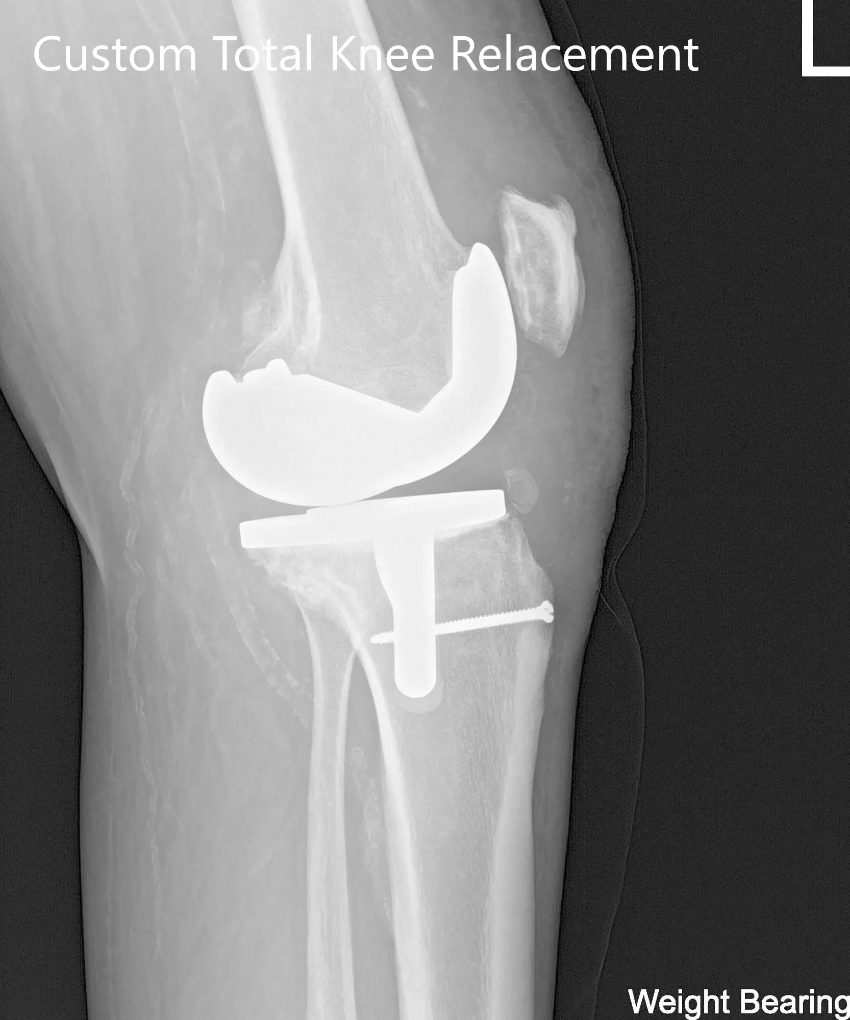 Radiografía postoperatoria de la rodilla izquierda que muestra visión AP y lateral - img 2