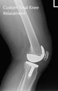 Postoperative X-ray images of the left knee in AP and lateral view - img 2