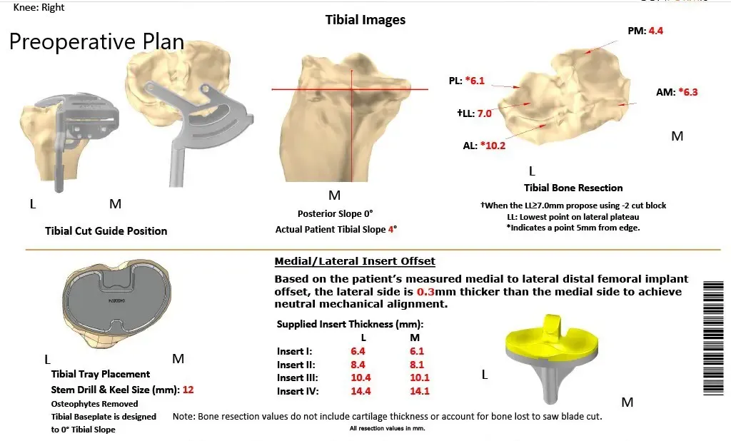 Complete Orthopedics patient specific surgical plan for a Customized Right Knee Replacement in a 71-year-old patient