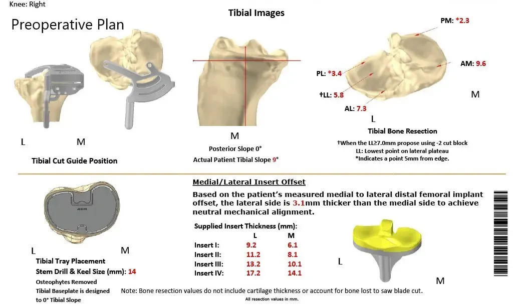 Plan quirúrgico completo de ortopedia específico para un reemplazo total de rodilla personalizado en una mujer de 58 años con artritis
