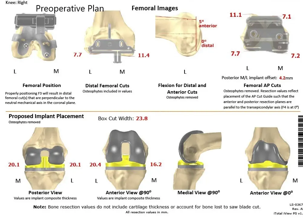 Plan quirúrgico específico para paciente de Ortopedia Completa para un reemplazo total de rodilla personalizado en una mujer de 58 años con artritis - ecografía 2