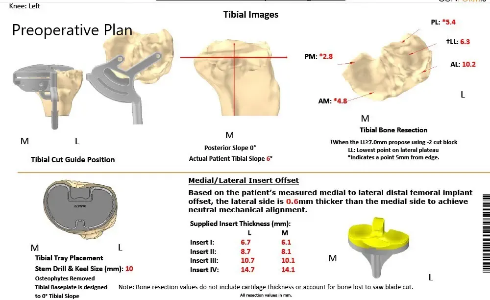 Plan quirúrgico completo específico para pacientes de Ortopedia para un reemplazo total personalizado de rodilla en un hombre de 59 años