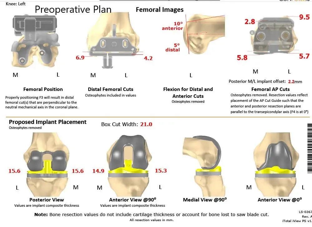 Plan quirúrgico completo específico para pacientes de Ortopedia para un reemplazo total de rodilla personalizado en un hombre de 59 años - ecografía 2