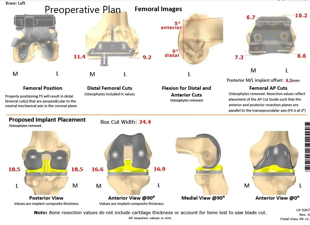 Complete Orthopedics patient specific surgical plan for a ustom Left Total Knee Replacement in a 66-year-old male - scan 2