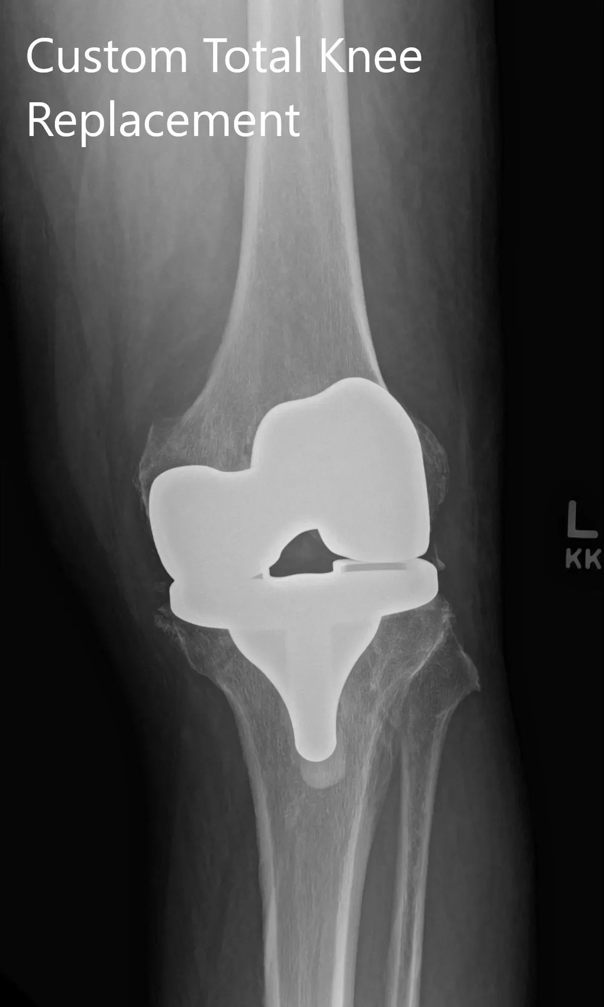 Postoperative X-ray showing AP and lateral images of the left knee