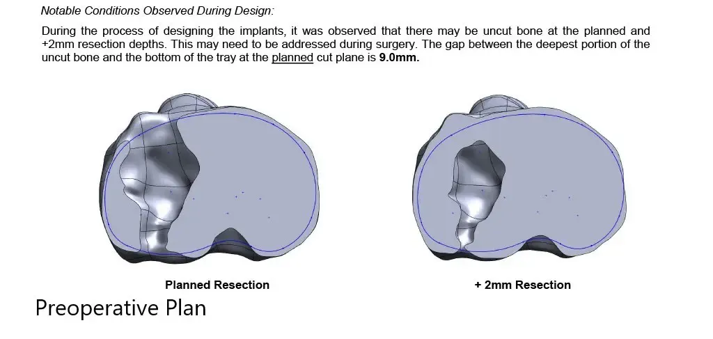 Complete Orthopedics patient specific surgical plan for a Custom Total Knee Replacement in Left Knee Arthritis with prior Hardware on the Lateral Tibial Plateau - scan 3