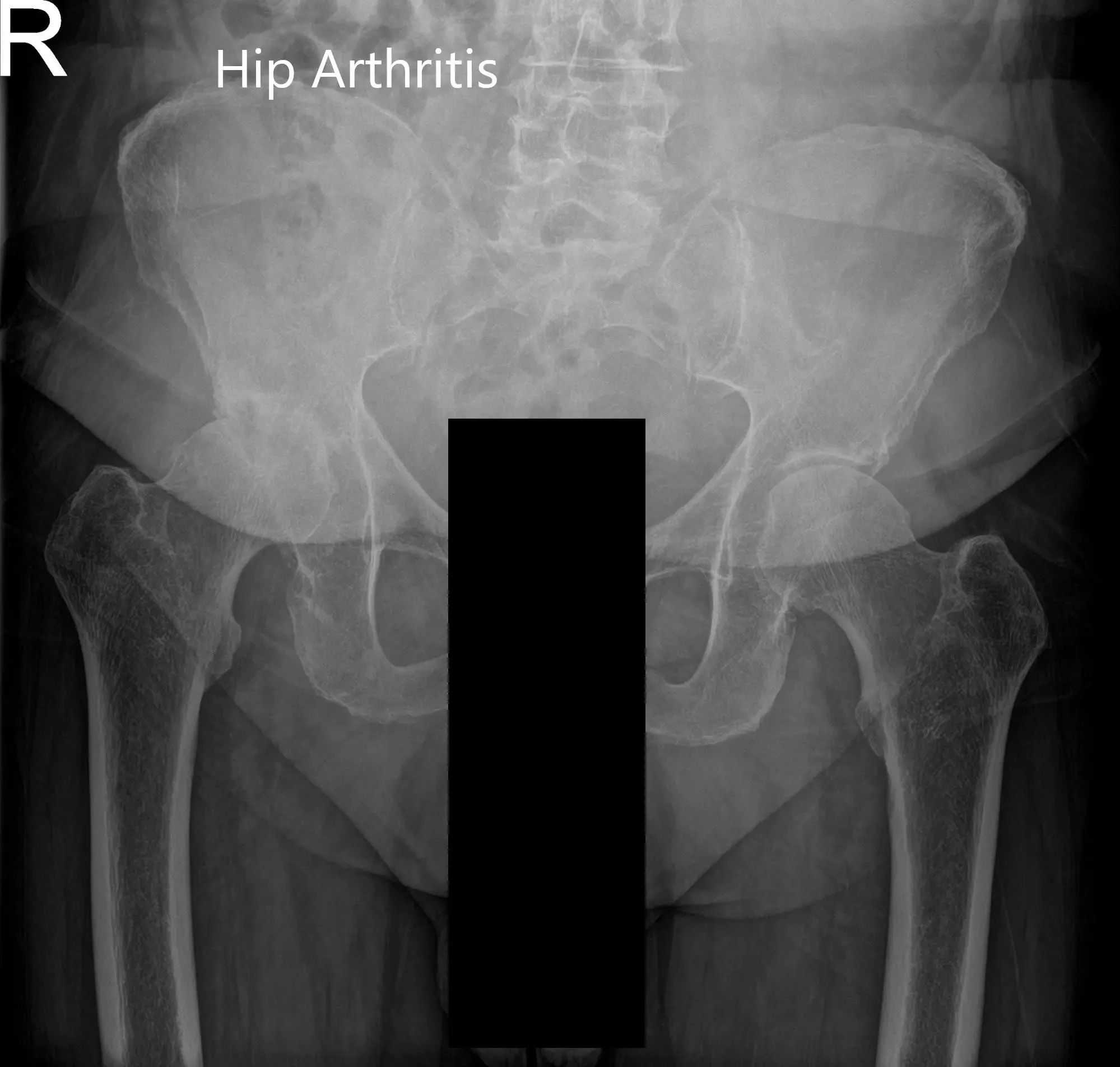 Preoperative X-ray of Pelvis AP view and frog legged lateral view of the right hip