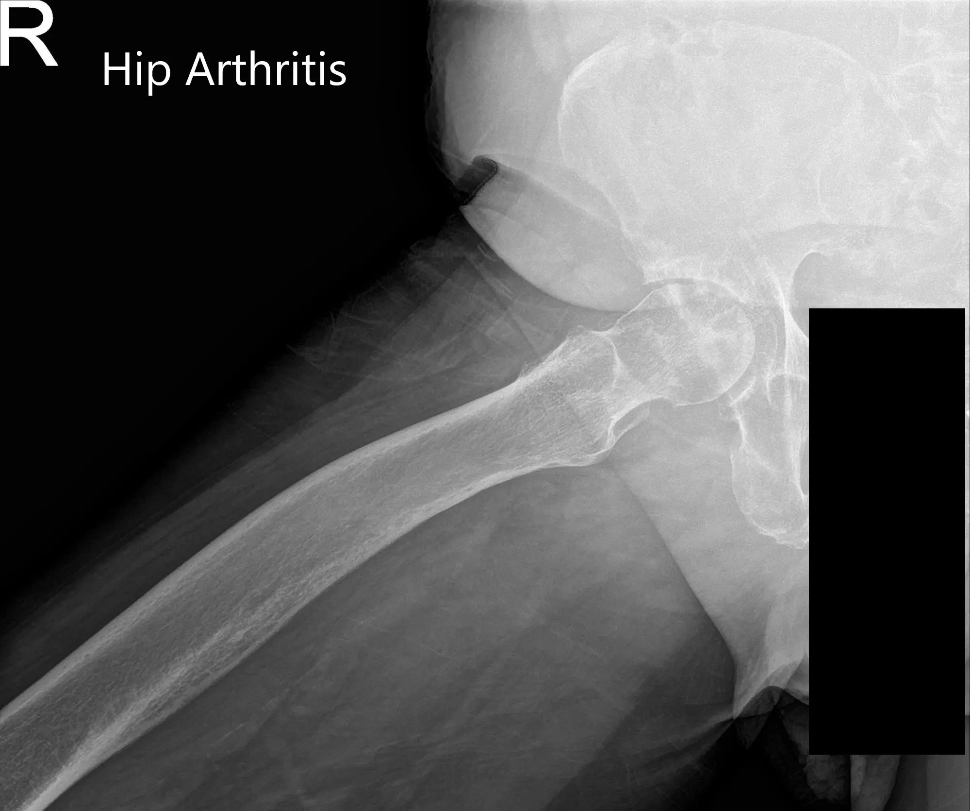 Preoperative X-ray of Pelvis AP view and frog legged lateral view of the right hip - img 2