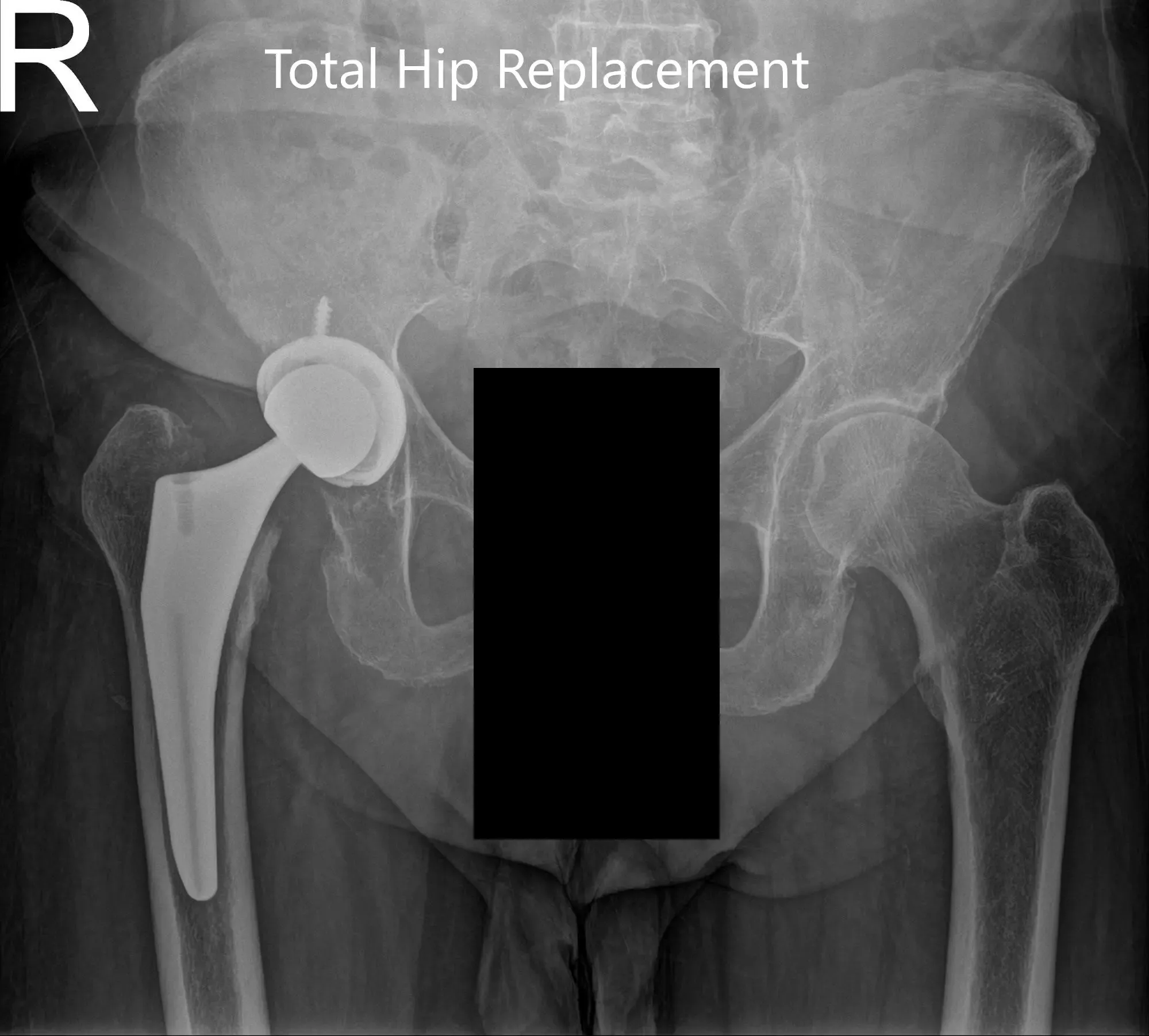 Postoperative X-ray showing the AP view of the pelvis and the frog-legged lateral view of the right hip - img 2