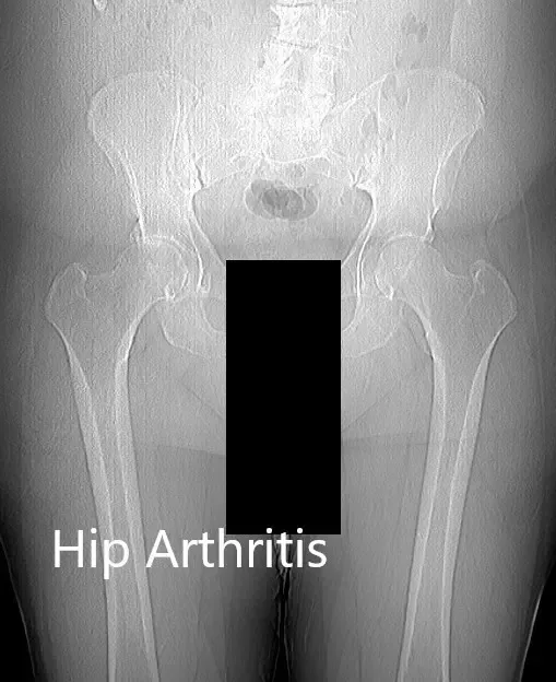 Radiografía preoperatoria de la pelvis del paciente con ambas caderas