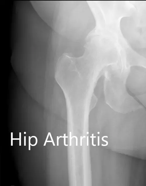 Radiografía preoperatoria que muestra la visión de la pata de rana y la pata lateral de la cadera derecha