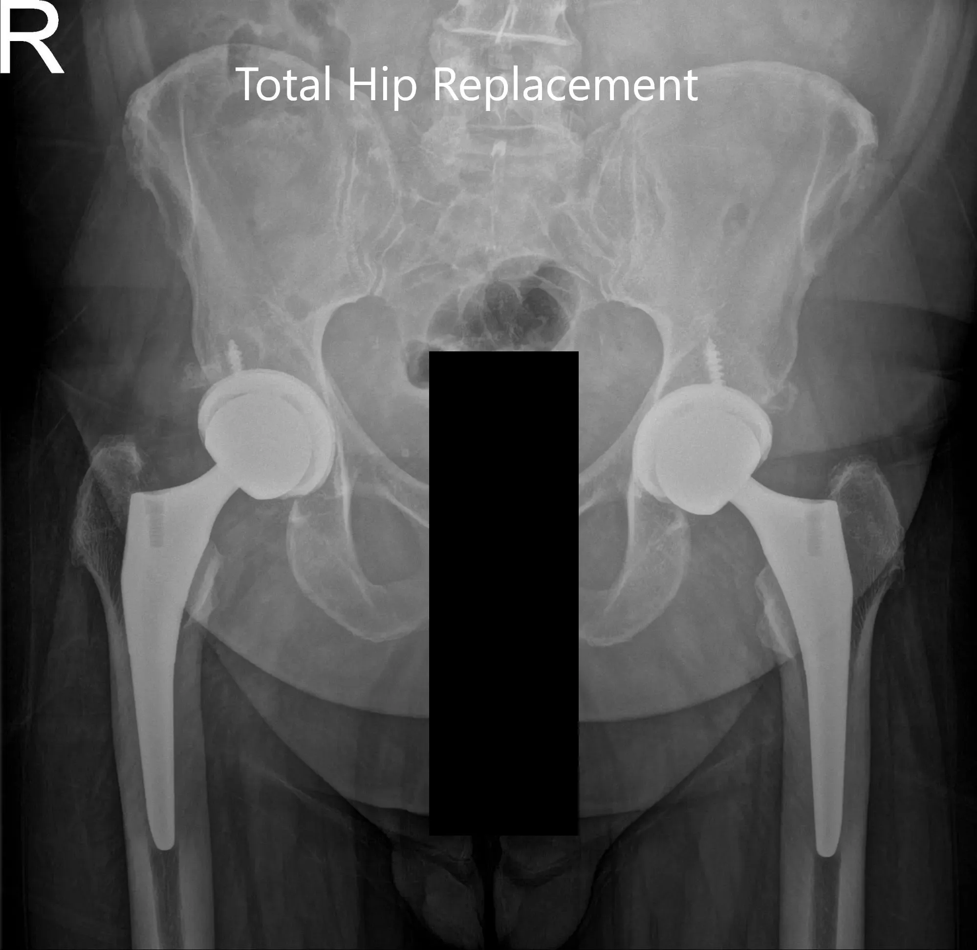 Postoperative AP view of the Pelvis X-ray showing both hip joints with frog-leg lateral views of the right and left hip joints