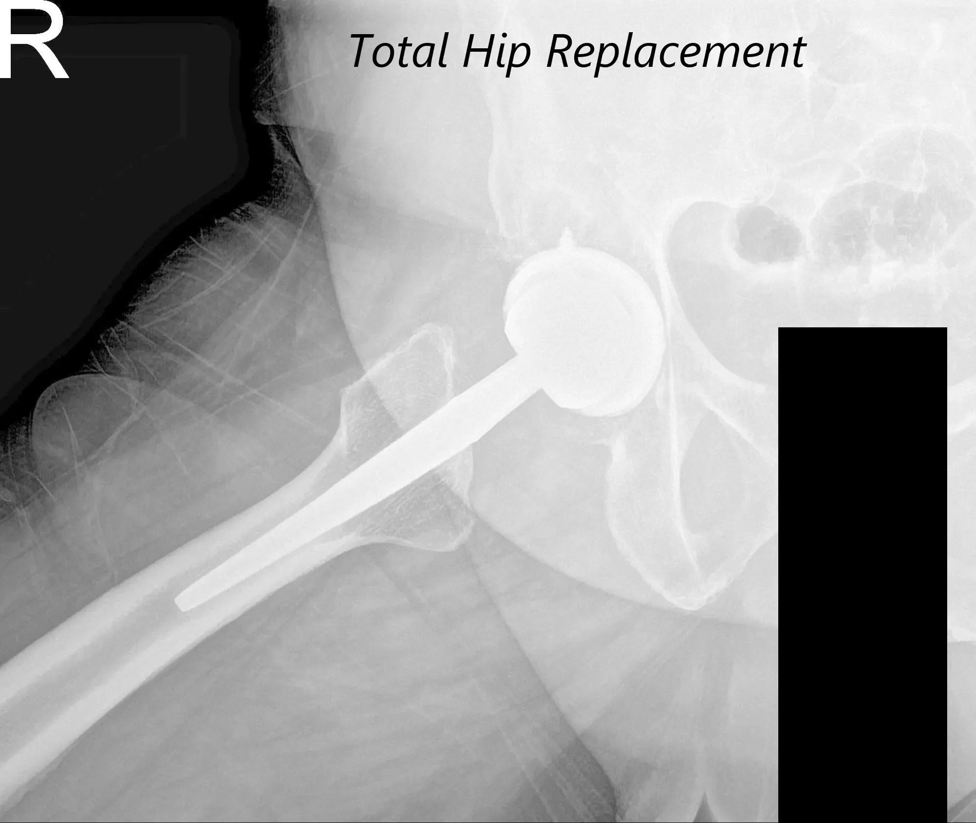 Postoperative AP view of the Pelvis X-ray showing both hip joints with frog-leg lateral views of the right and left hip joints - img 2