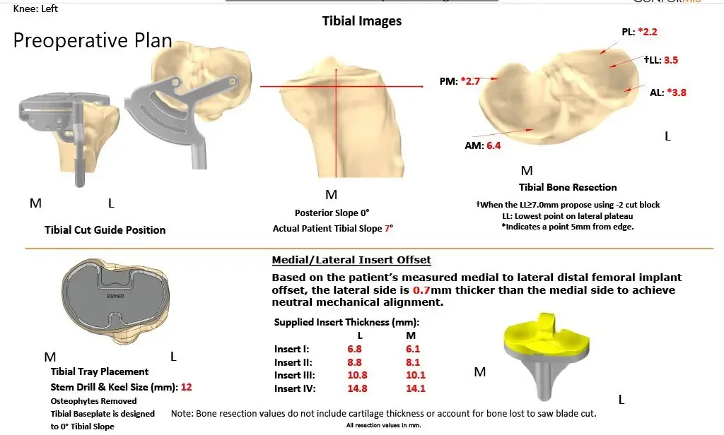 Plan quirúrgico completo específico para pacientes en ortopedia para un reemplazo personalizado de rodilla izquierda para artritis postraumática en un hombre de 45 años