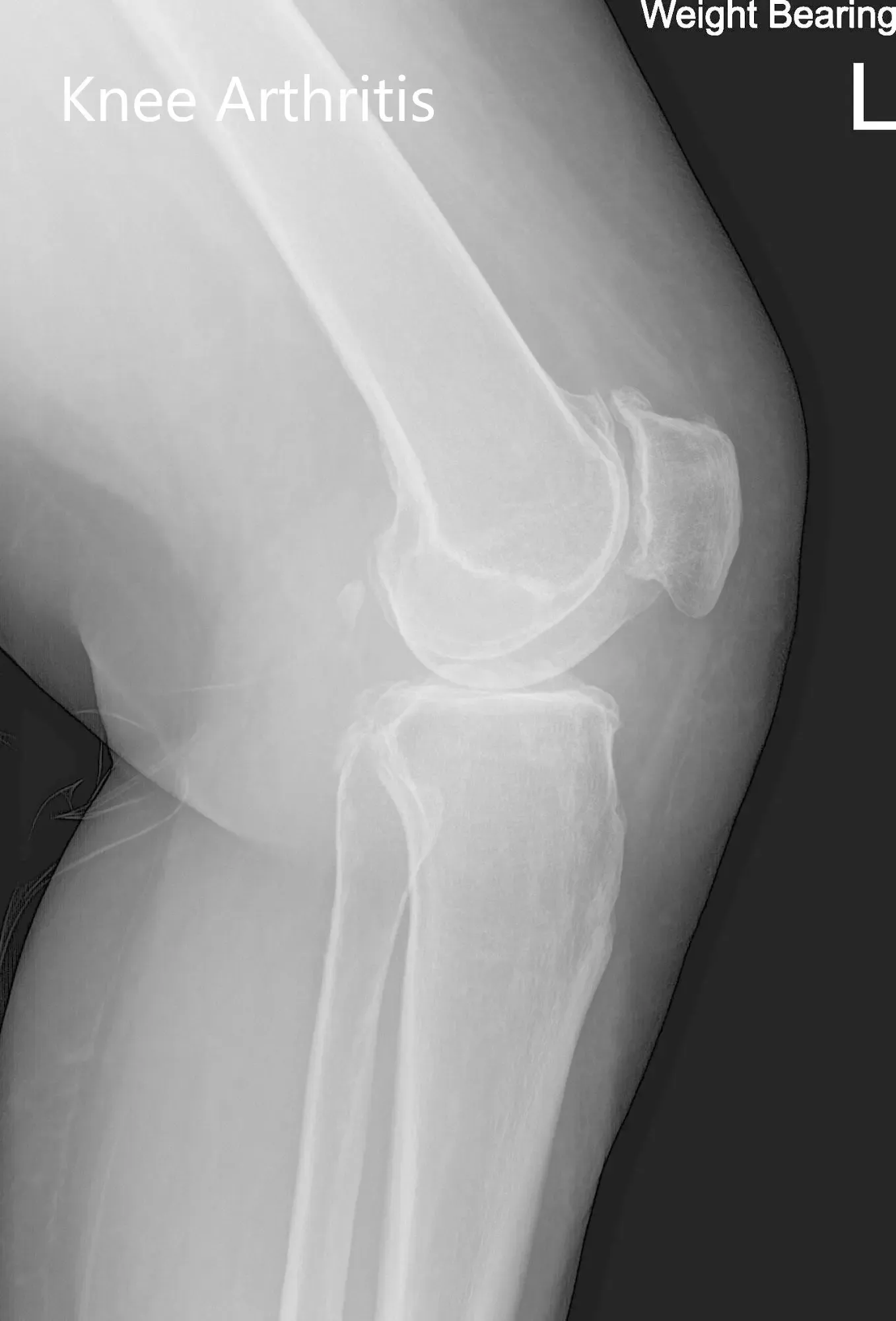 Preoperative X-ray of the left knee showing AP and lateral views