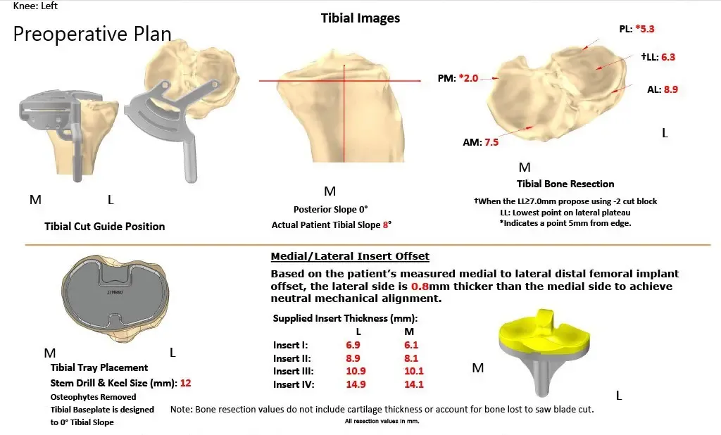 Complete Orthopedics patient specific surgical plan for a Custom Left Knee Replacement in a 40 year male